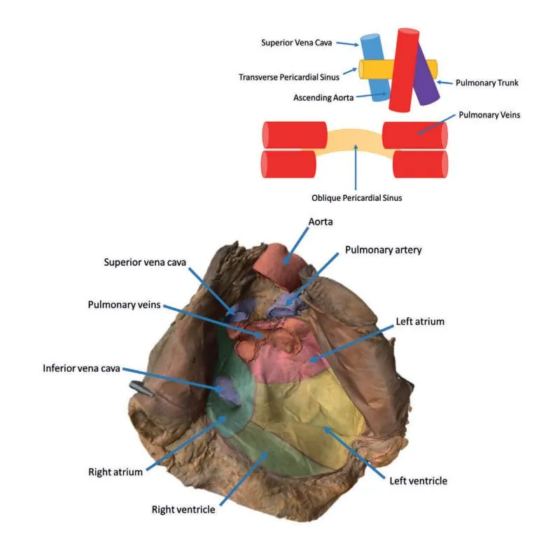 3D Printed Pericardial Space